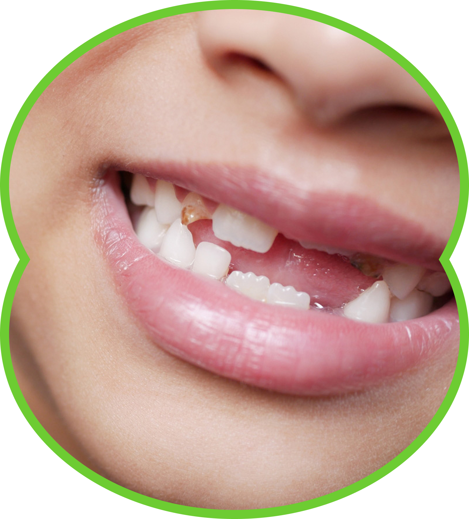 Close-up of a person's smile, showing teeth with a slight gap, and pink lips.