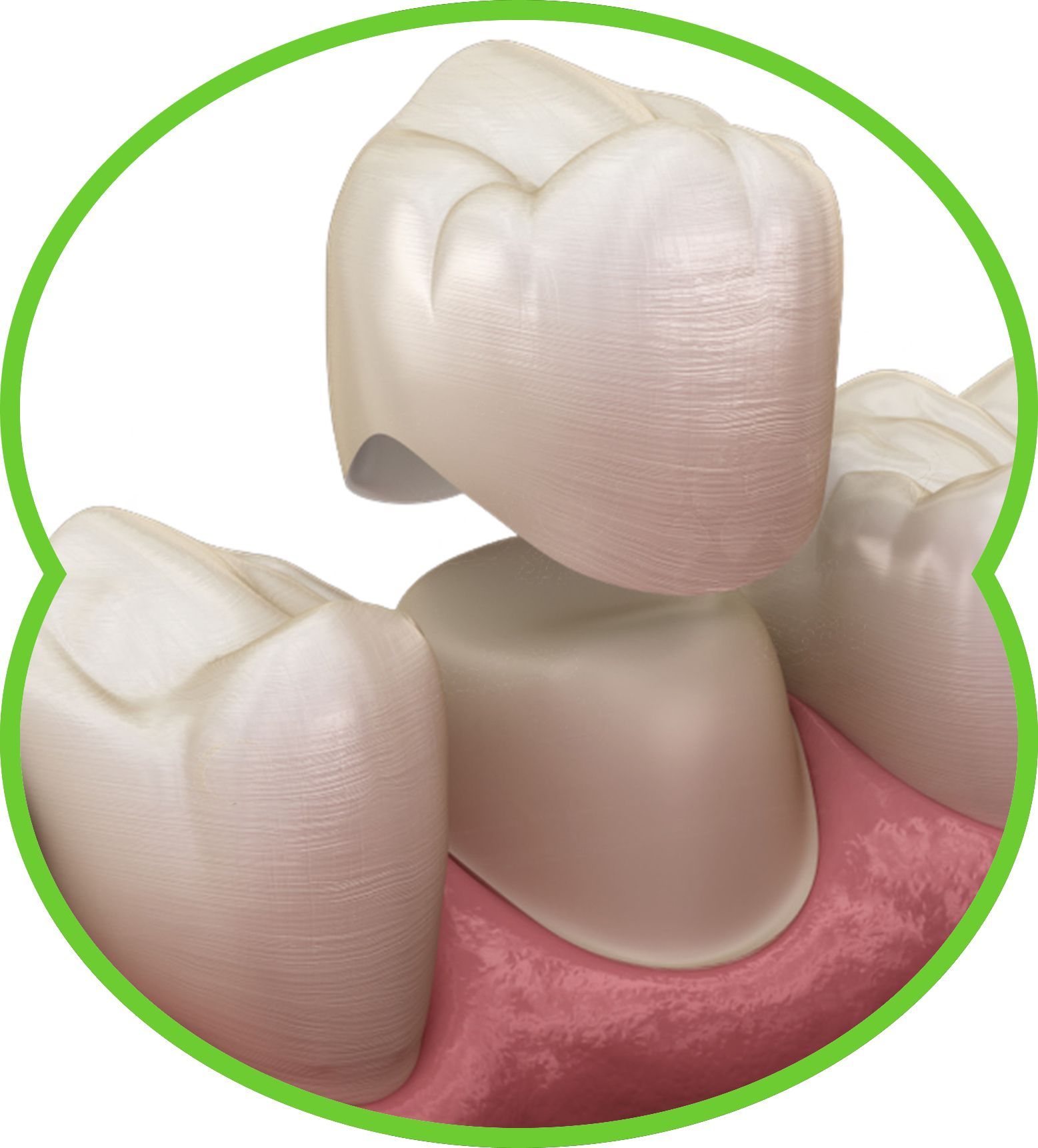 NuSmile Signature pediatric crowns in a clear plastic container.