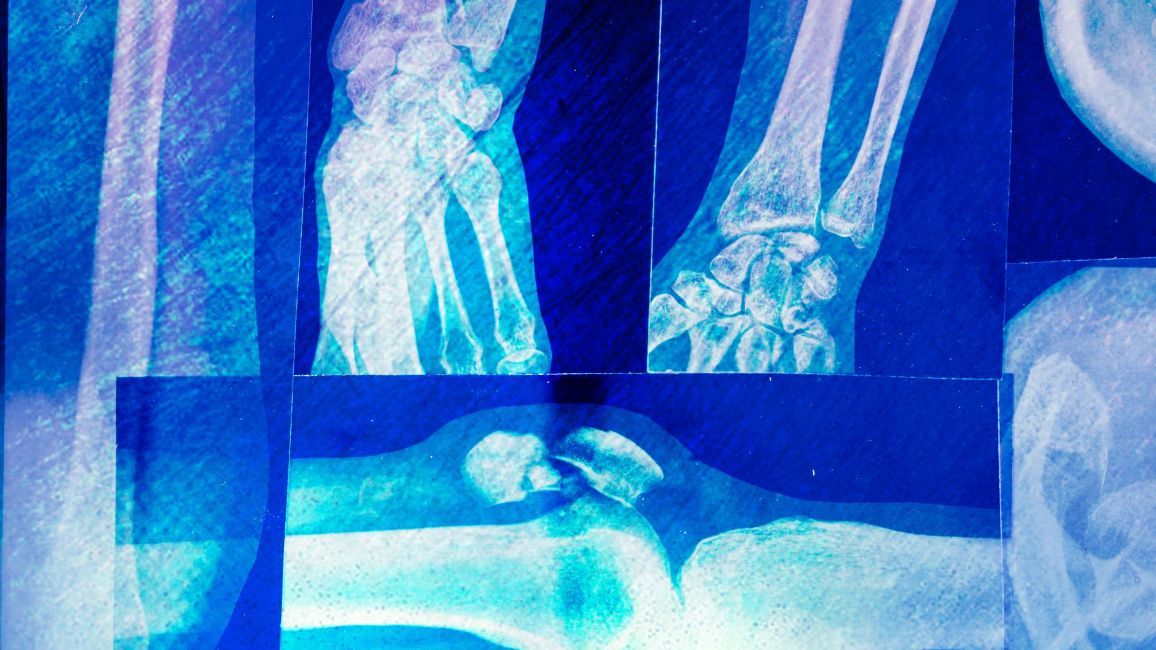 a blue x-ray of a person 's arm and wrist .