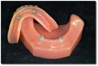 Implant Supported Denture - Resnevic Dental in Chepachet, RI