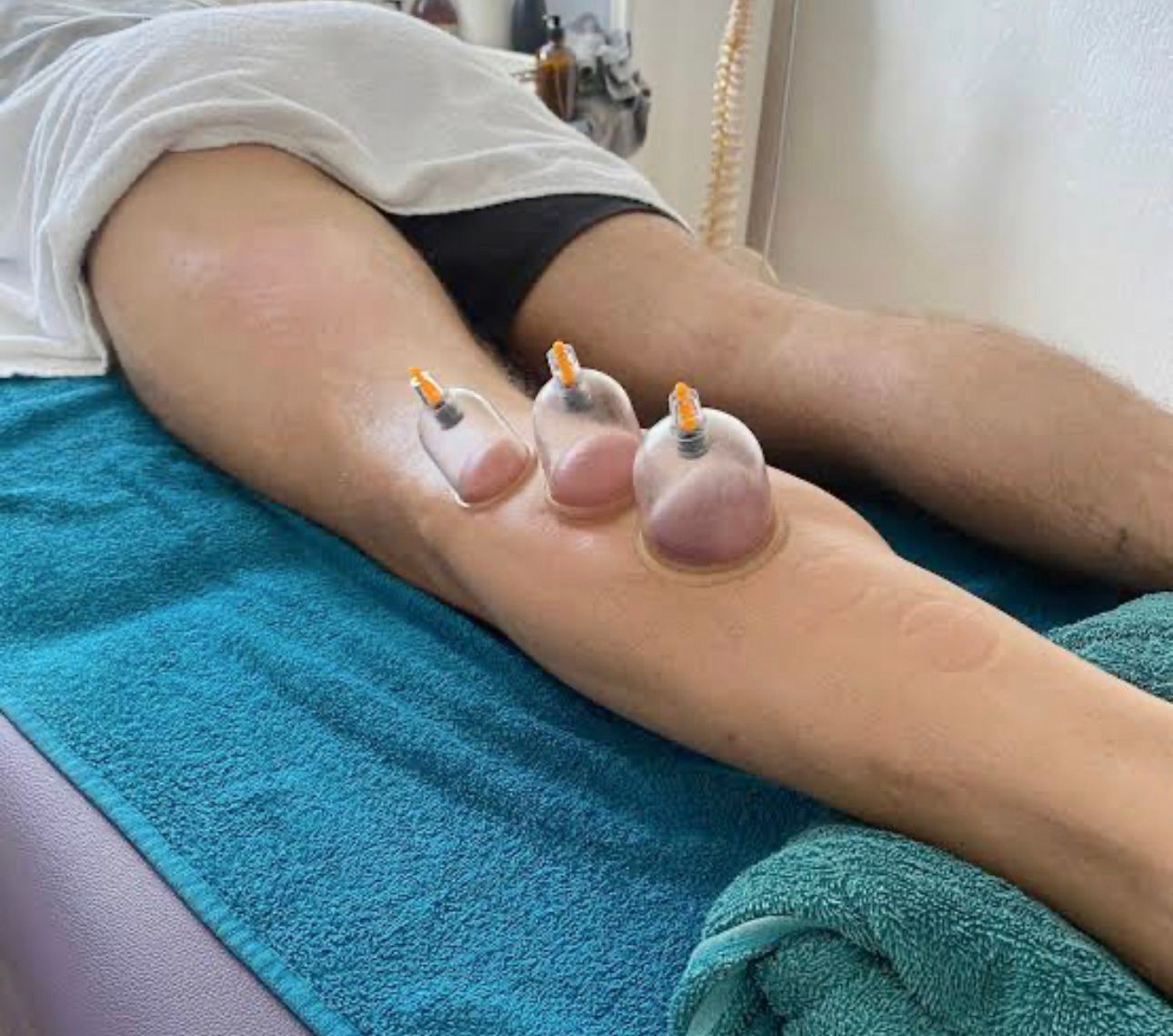 Book a remedial massage with cupping at Self Heal Me