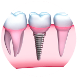 Learn the Dental Implants Dental Implants at Teeth@Mittagong