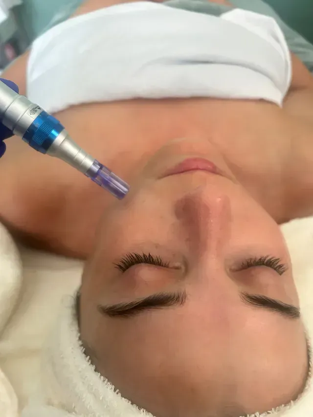Microneedling treatment being applied to skin to stimulate collagen and improve texture at Spa La La Tampa Microneedling treatment being applied to skin to stimulate collagen and improve texture at Spa La La Tampa