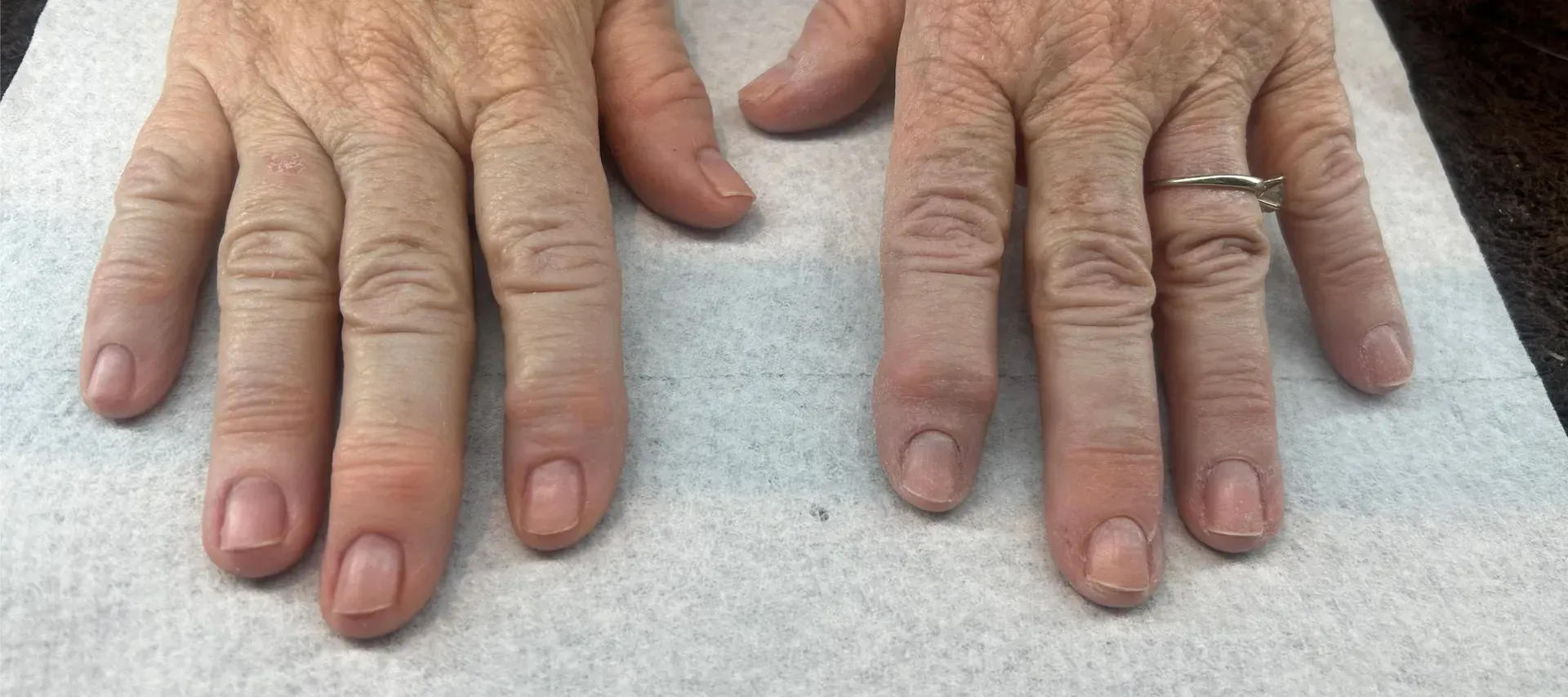 Two hands with natural nails and one hand wears a ring.