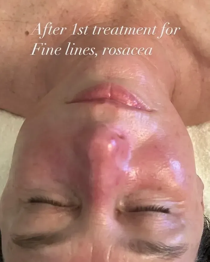After 1st treatment for fine lines and rosacea.
