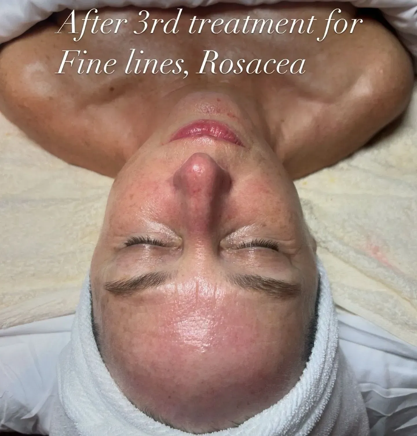 Face with closed eyes after 3rd treatment for fine lines and rosacea.