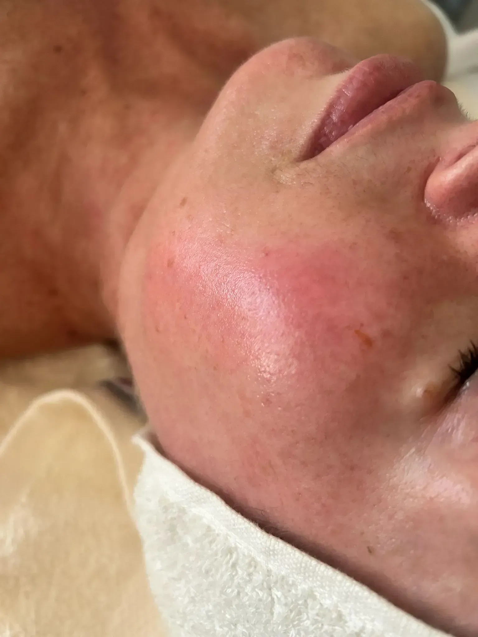 Close-up of a person's face after a facial treatment, showing a red, glowing complexion.