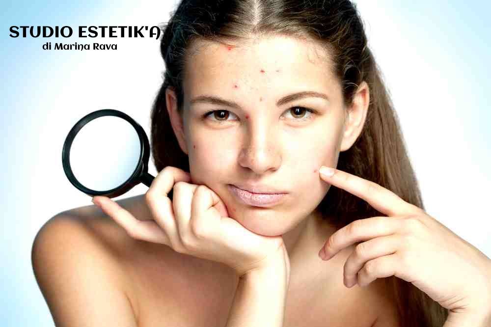 Giovane affetta da acne