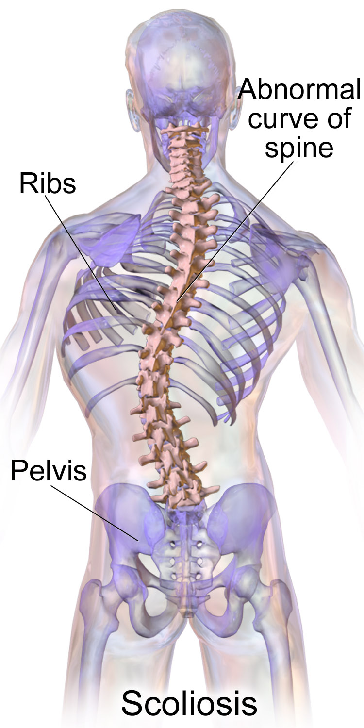 scoliosis therapy st petersburg