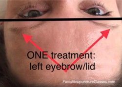 Rosacea Treatment on right side of face| Maryville, TN | Inspirational Medicine
