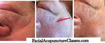 Facial acupuncture before, during and after | Maryville, TN | Inspirational Medicine