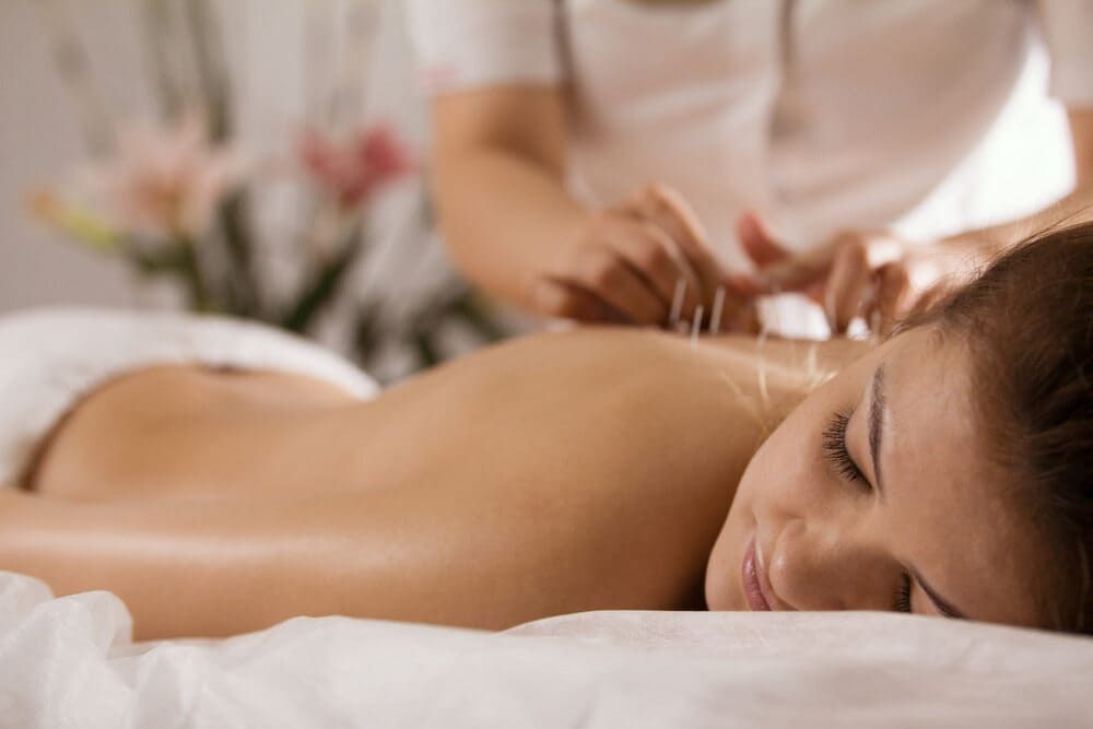 A Woman Is Getting Acupuncture On Her Back In A Spa — Sea & Sand Chiropractic In Toukley, NSW