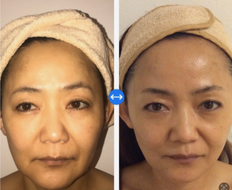 Before and After Facial Treatment — Vancouver, BC — Iki Total Body Care