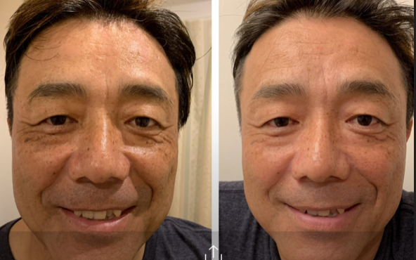Before and After Treatment — Vancouver, BC — Iki Total Body Care