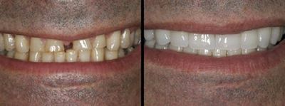 White Fillings, Dentist McMurray PA