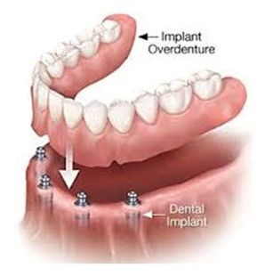 White Fillings, Dentist McMurray PA