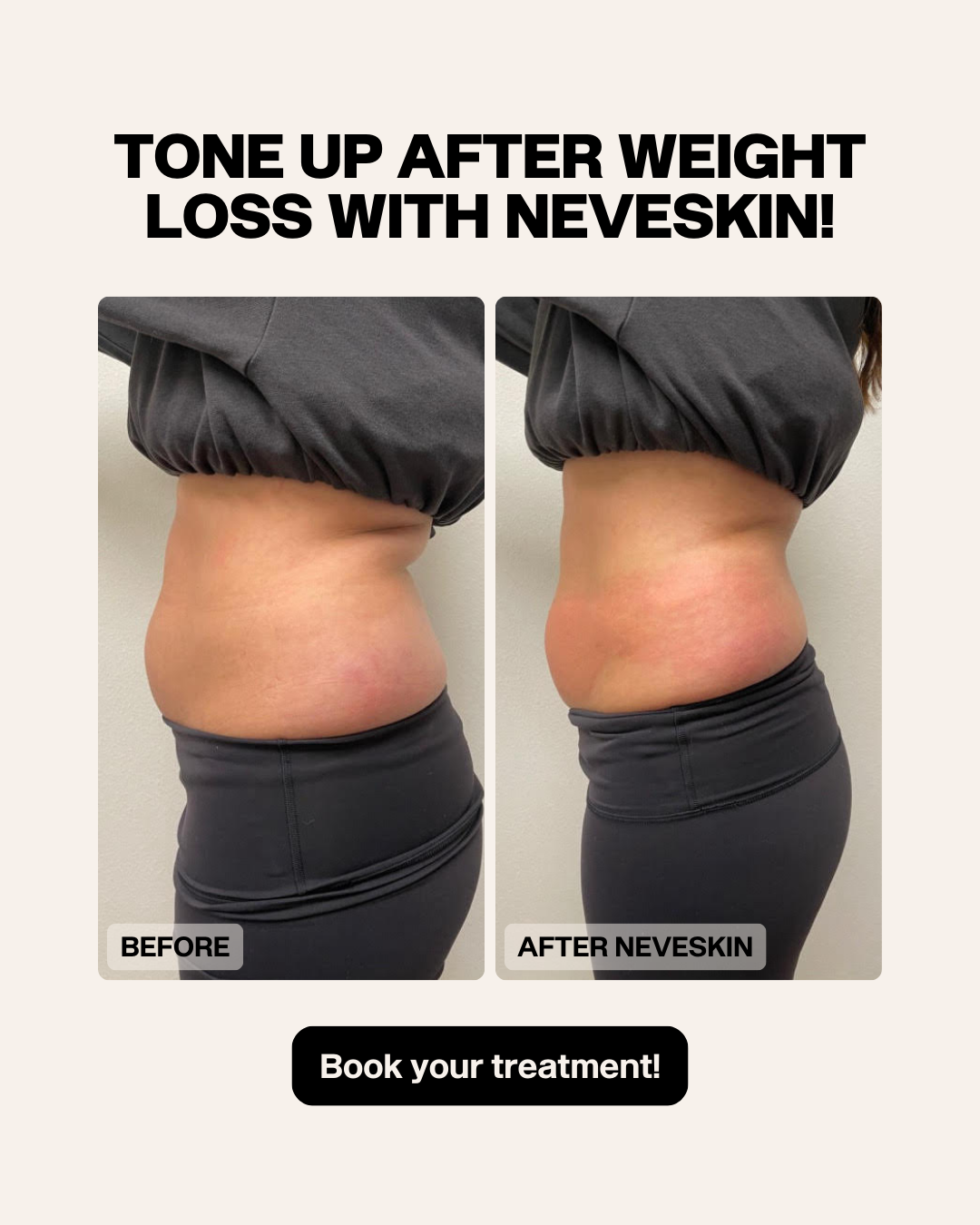 Side-by-side abdomen images showing skin tightening. Before: loose skin. After: tighter skin. Text: