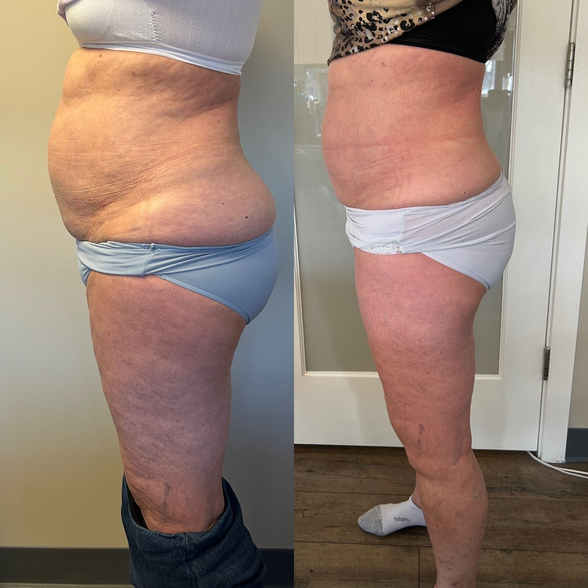 Side-by-side photos showing a woman's body before and after a procedure, revealing body contouring results.