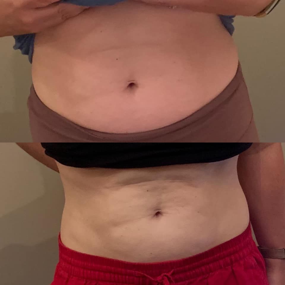 Side-by-side comparison of a person's abdomen: before and after, showing a flatter stomach.