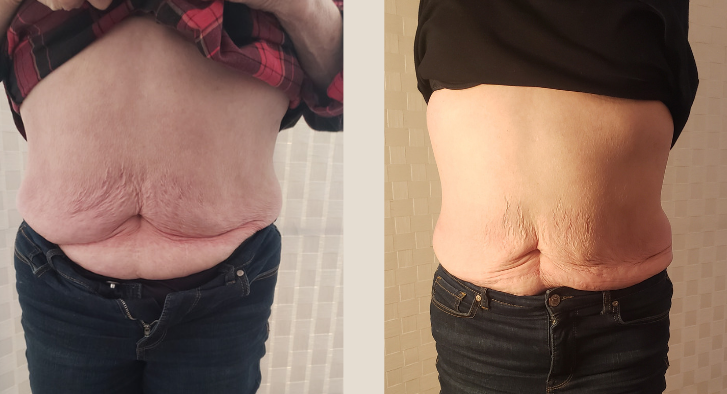 Two views of a person's midsection, before and after, showing changes to the abdominal skin.