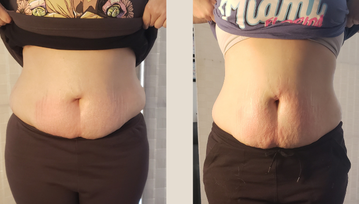 Two photos showing a person's abdomen; the left shows a belly in dark clothing, and the right reveals a slight reduction.