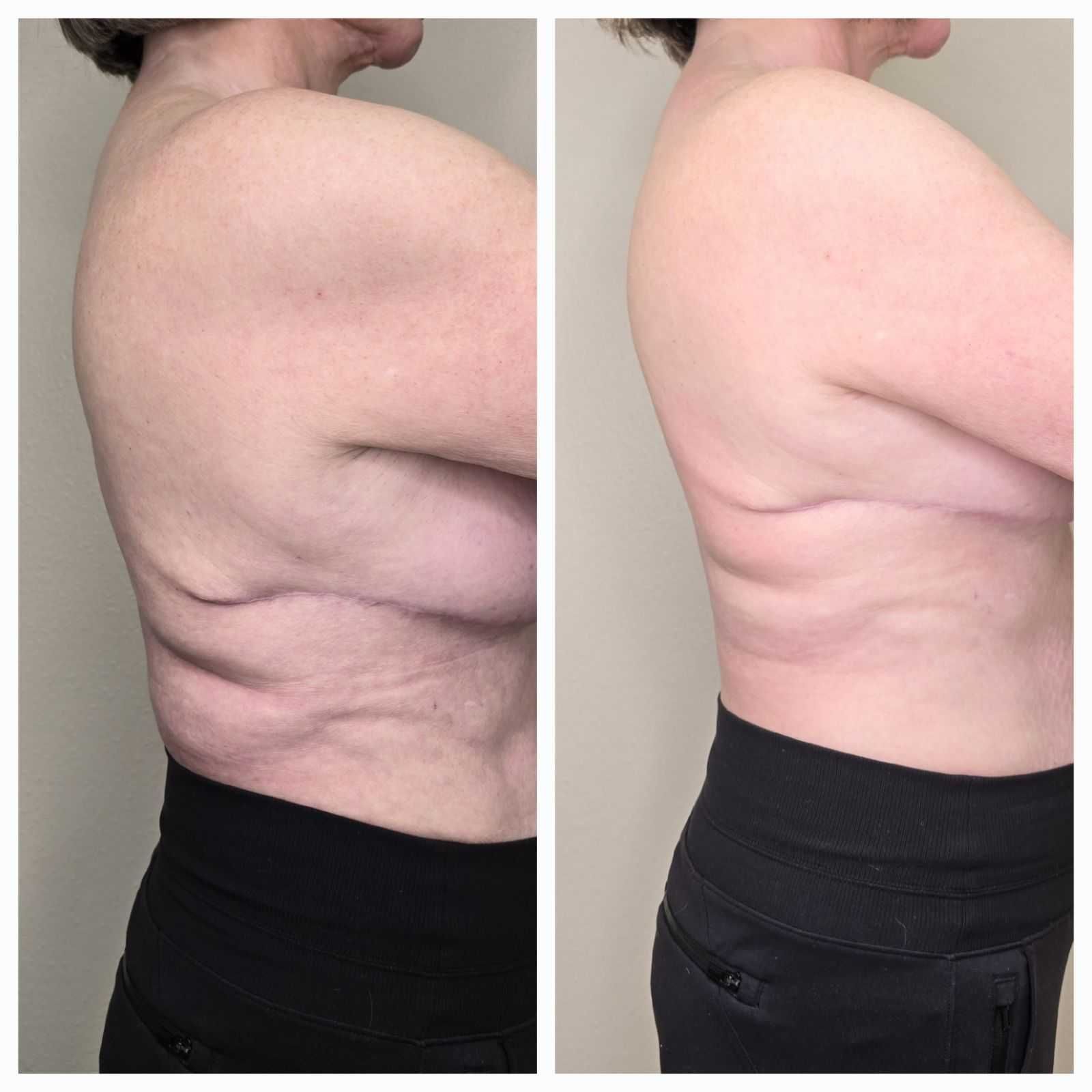 Side-by-side comparison. Woman's torso before and after a procedure, showing reduction in skin laxity.