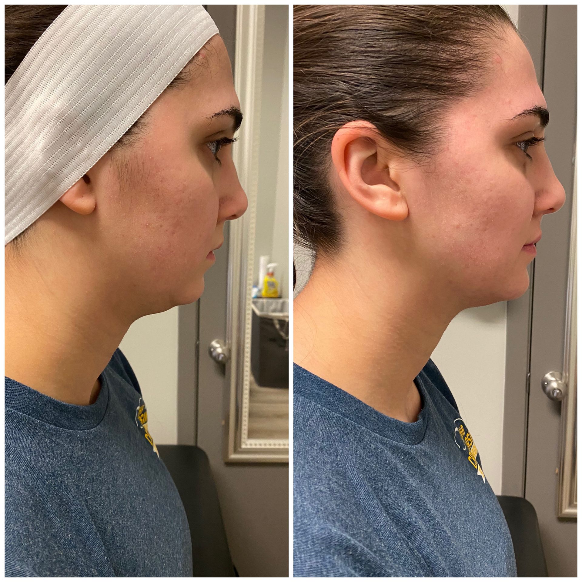 Side-by-side photos of a woman's face before and after a procedure.  Skin appears smoother and hair is removed.