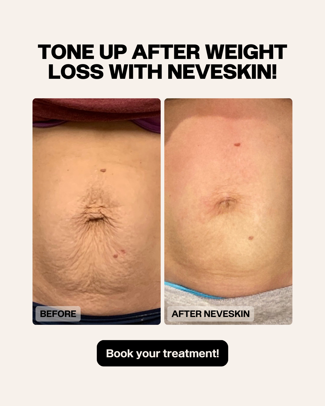 Before-and-after abdominal photos. Text