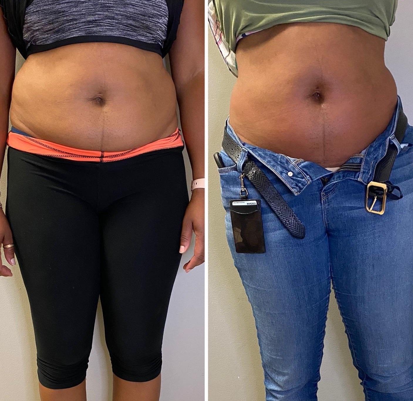 Side-by-side before-and-after photos of a person's abdomen. Showing a reduction in belly size.