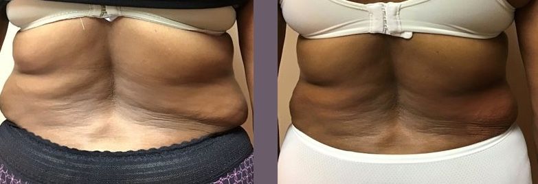 Before and after view of a person's back showing reduction of fat folds; dark skin tone; white bra.