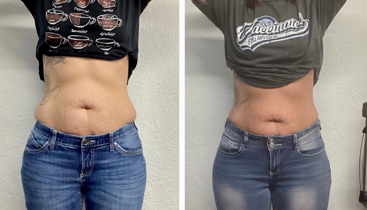 Before and after photos show a woman's stomach. The after photo shows a reduction in belly fat.