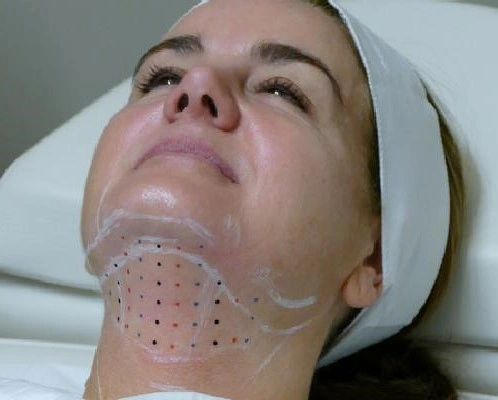 Woman receiving cosmetic procedure, with dots marked on her chin and neck.