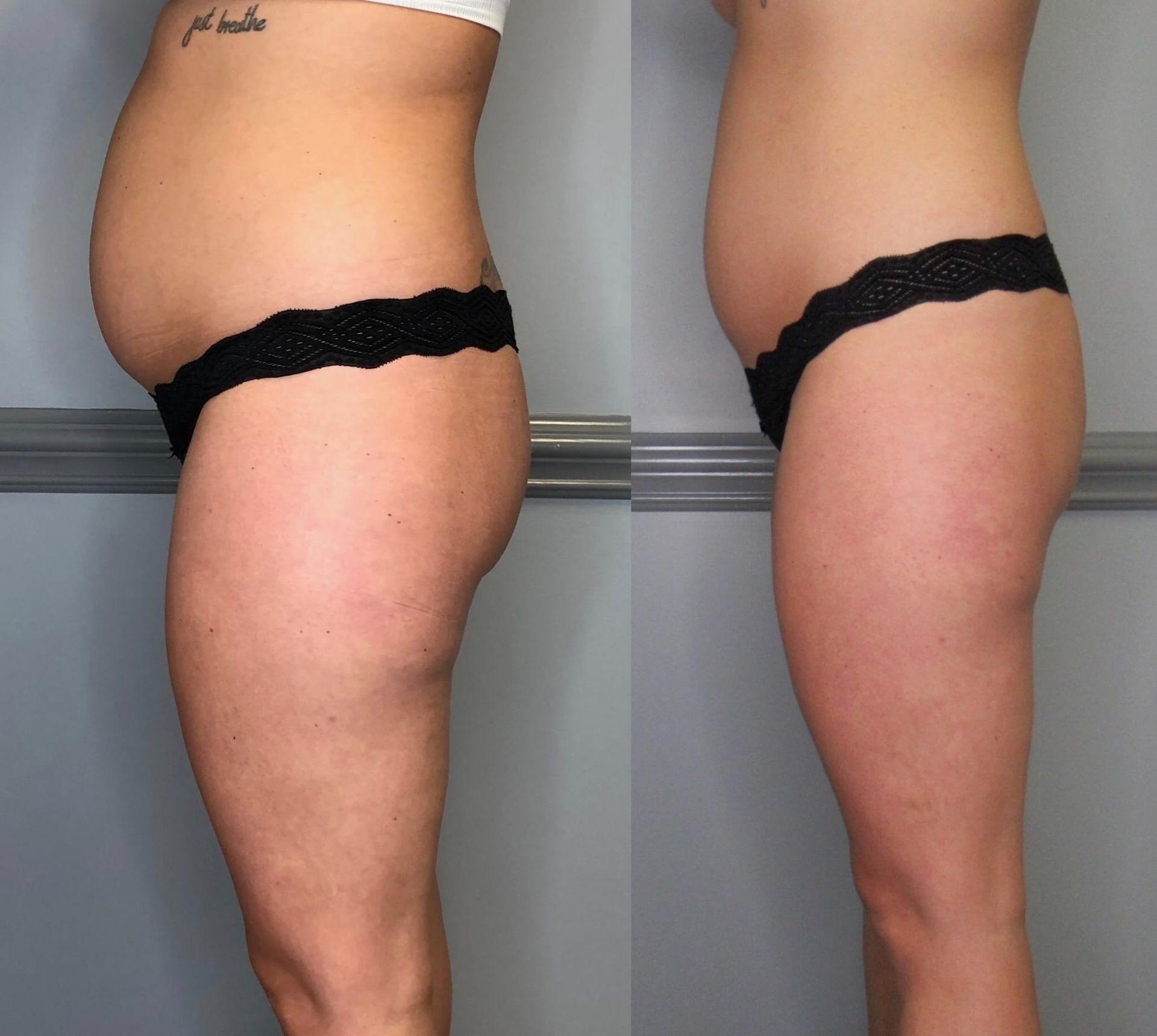 Before and after side views of a person with less abdominal fat and toned thighs.