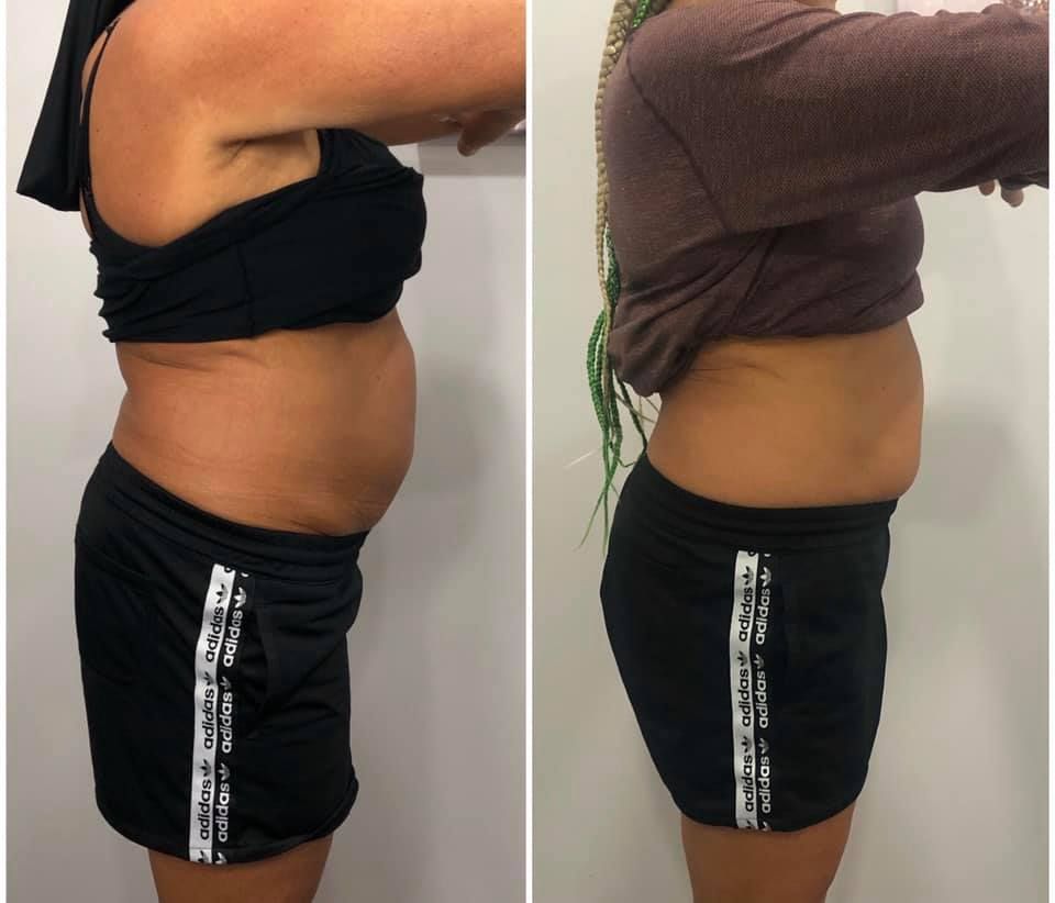 Side-by-side photos: Before and after of a person's abdomen. Shows a decrease in belly fat after treatment.