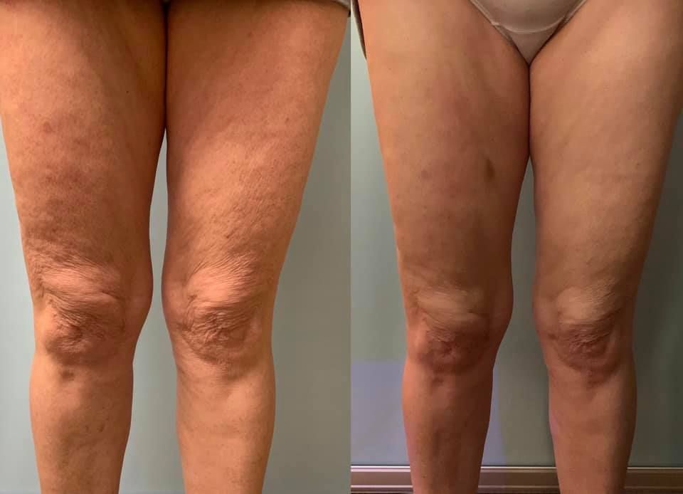 Before and after photos of legs, cellulite reduced on the right. Knees are visible.