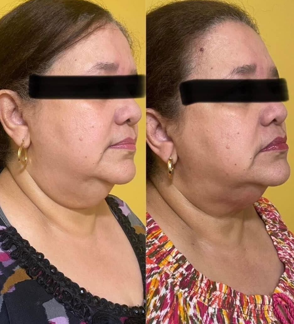 Before-and-after of a woman's neck profile, showing a reduction in submental fullness after a procedure.