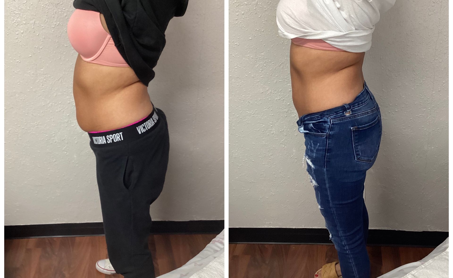 Side-by-side view, woman before and after treatment. Shows torso in pink bra and jeans. Dark pants in first.
