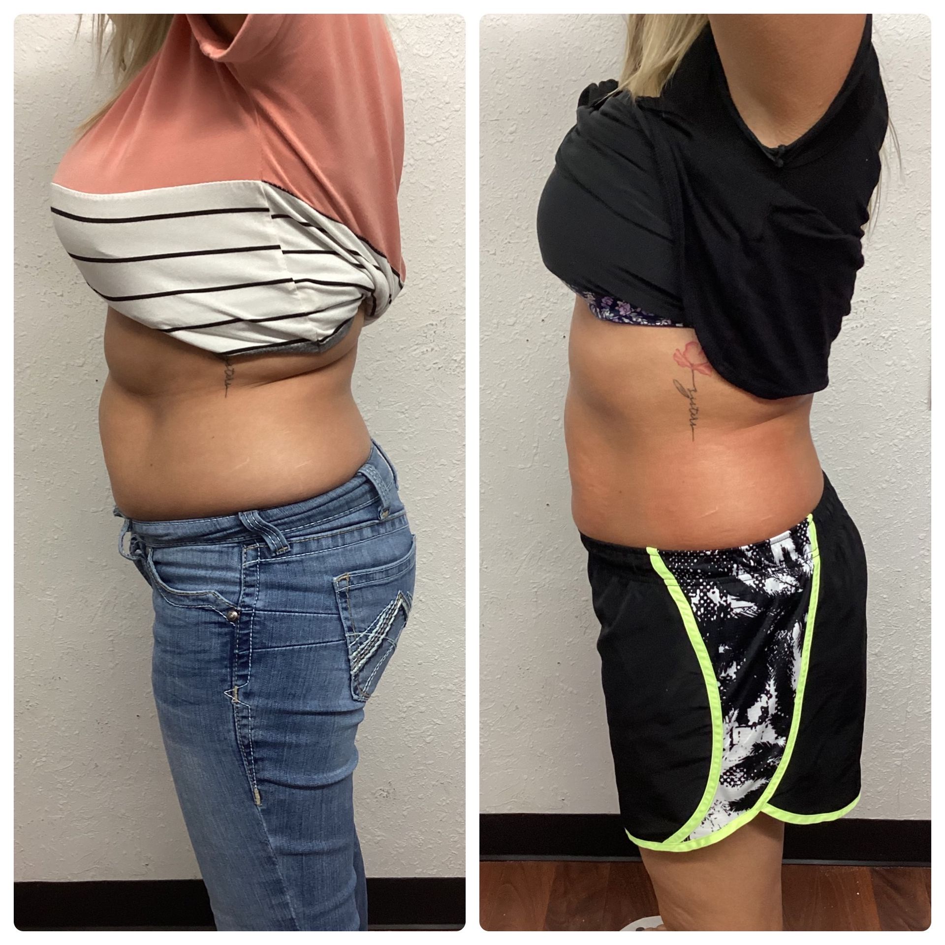 Side-by-side photos showing a woman's abdomen before and after a body contouring procedure.