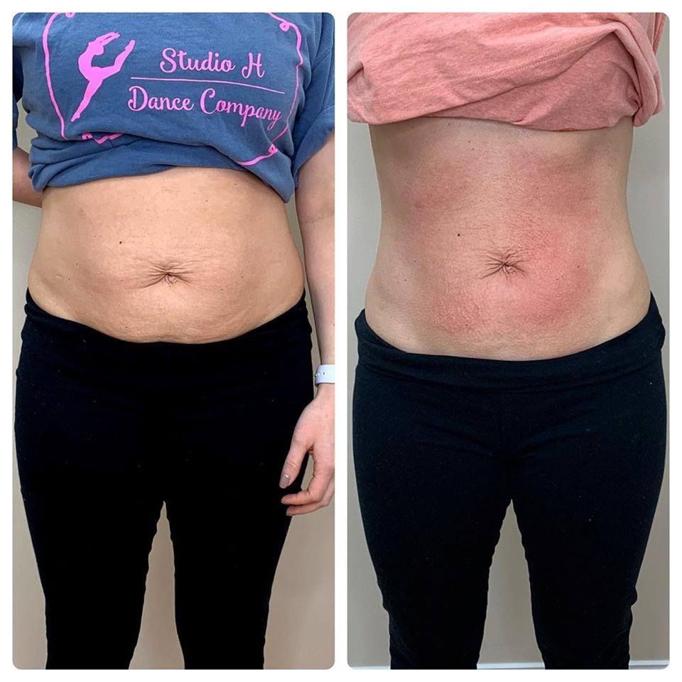 Side-by-side photos of a woman's torso, before and after, wearing black pants. The after shows red skin on abdomen.