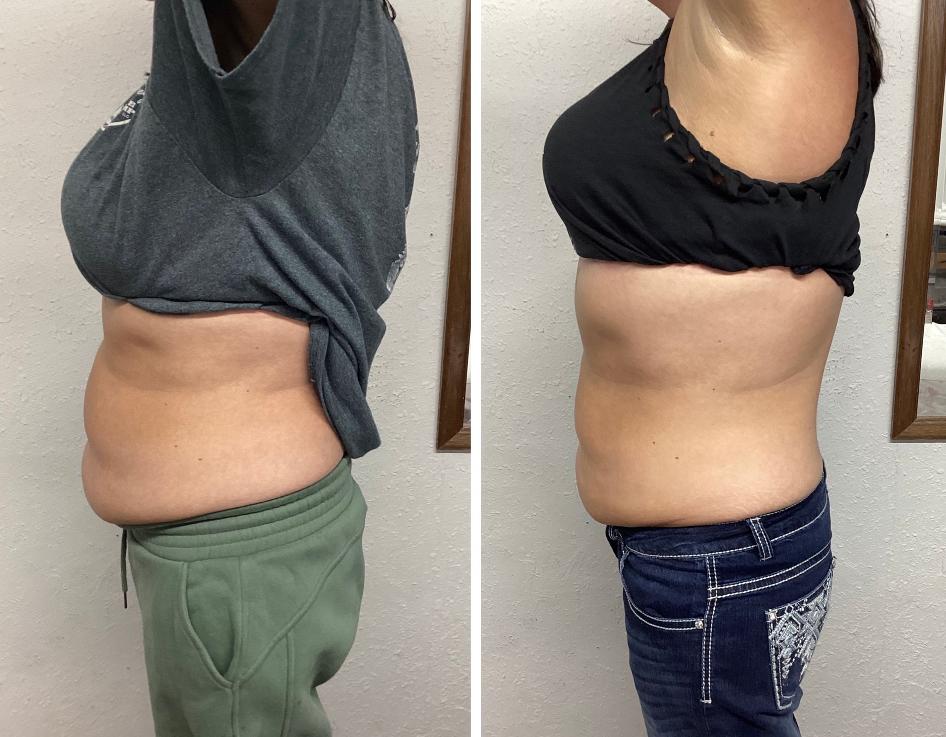 Side-by-side comparison of a woman's abdomen. 