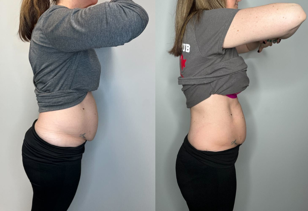 Two side-view photos show a woman's midsection before and after.