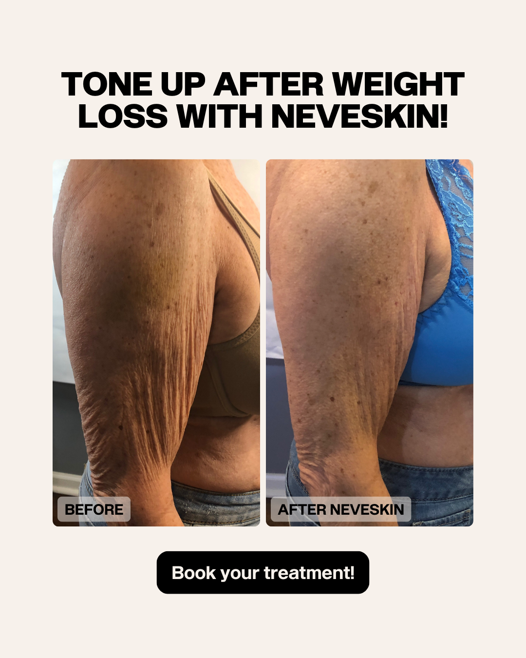 Before and after images of arm skin, using Neveskin treatment.