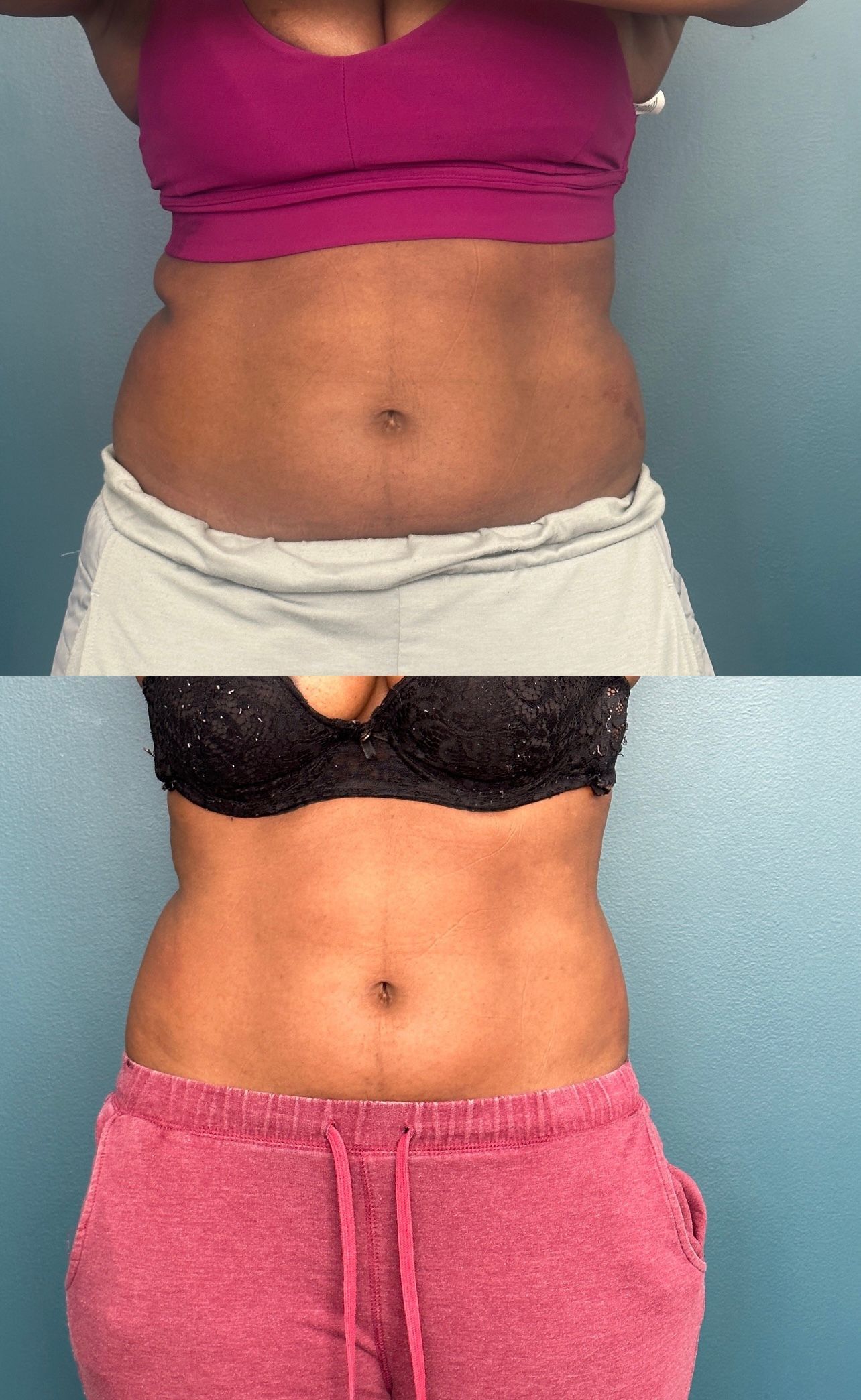 Before-and-after abdominal photos:  top photo shows belly bulge, bottom photo shows flatter stomach.