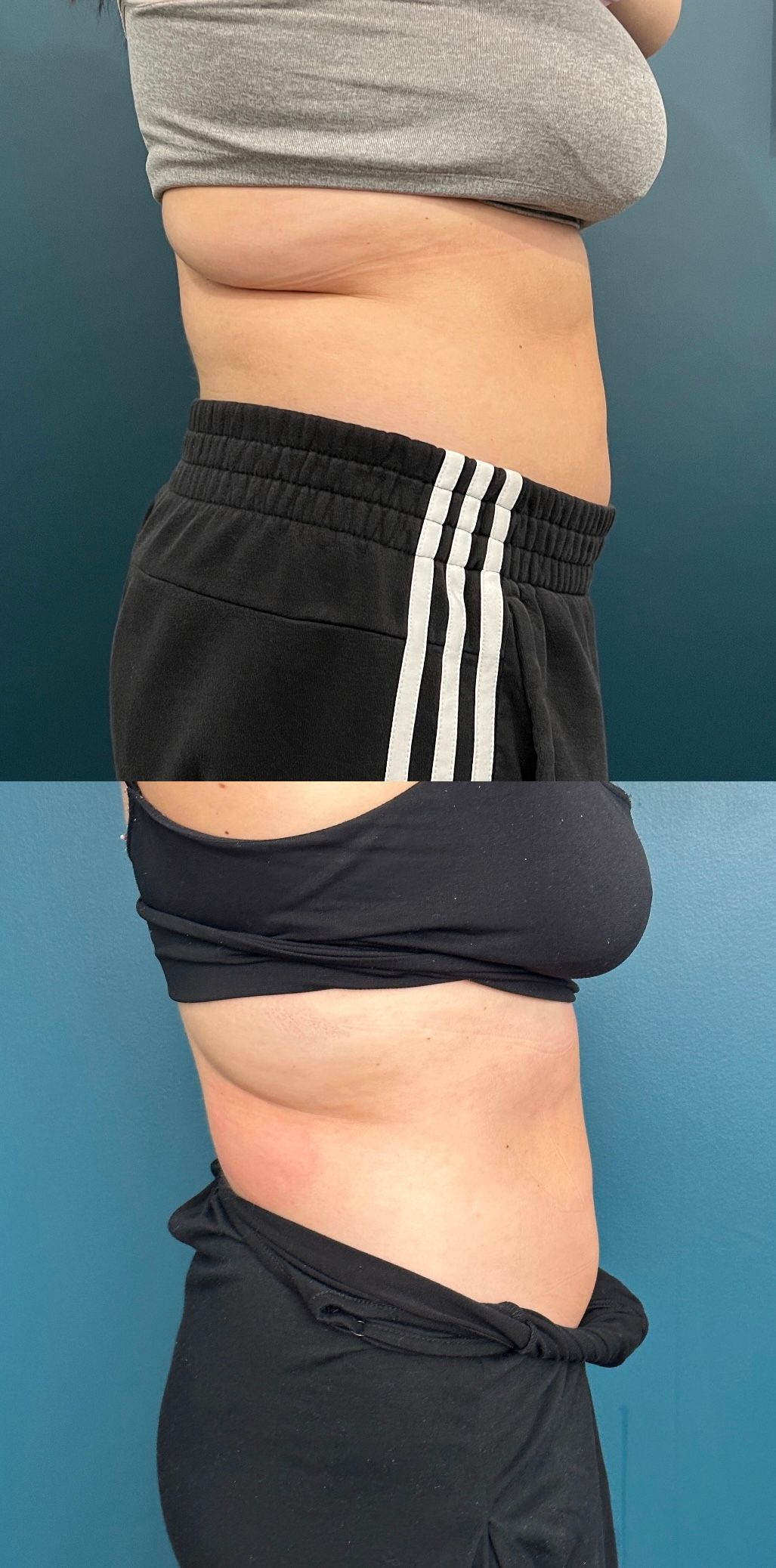 Side-by-side body comparison of a person before and after a procedure, showcasing changes in the abdominal area.
