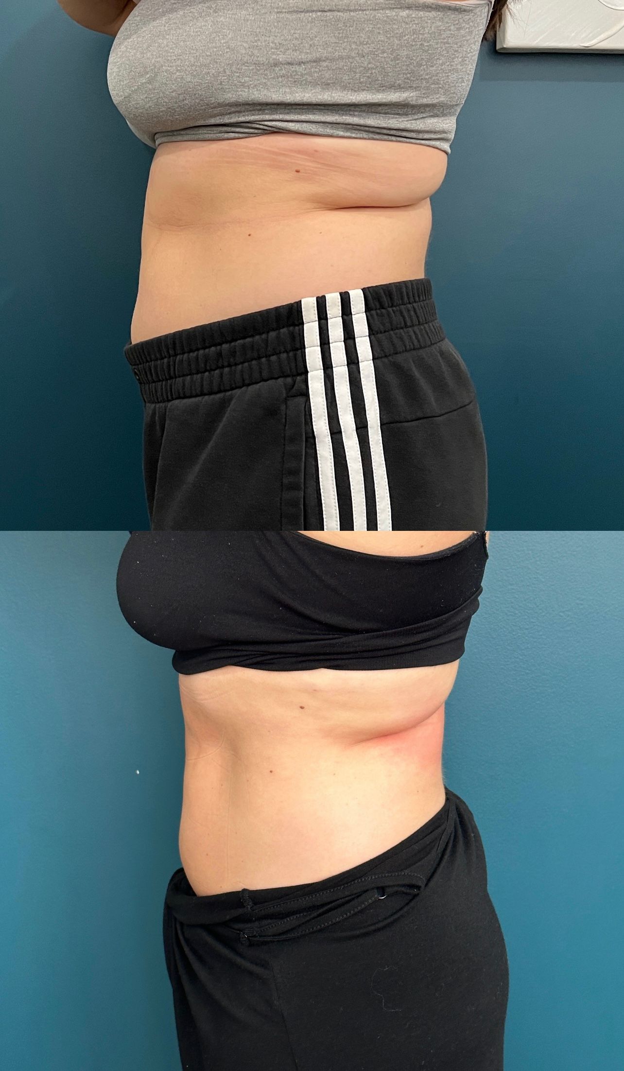 Before and after side view comparison of a person's torso, showing reduced belly fat.