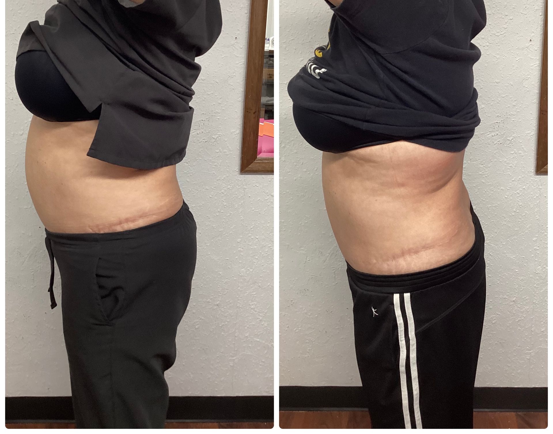 Two side-view photos showing a person's abdomen. 