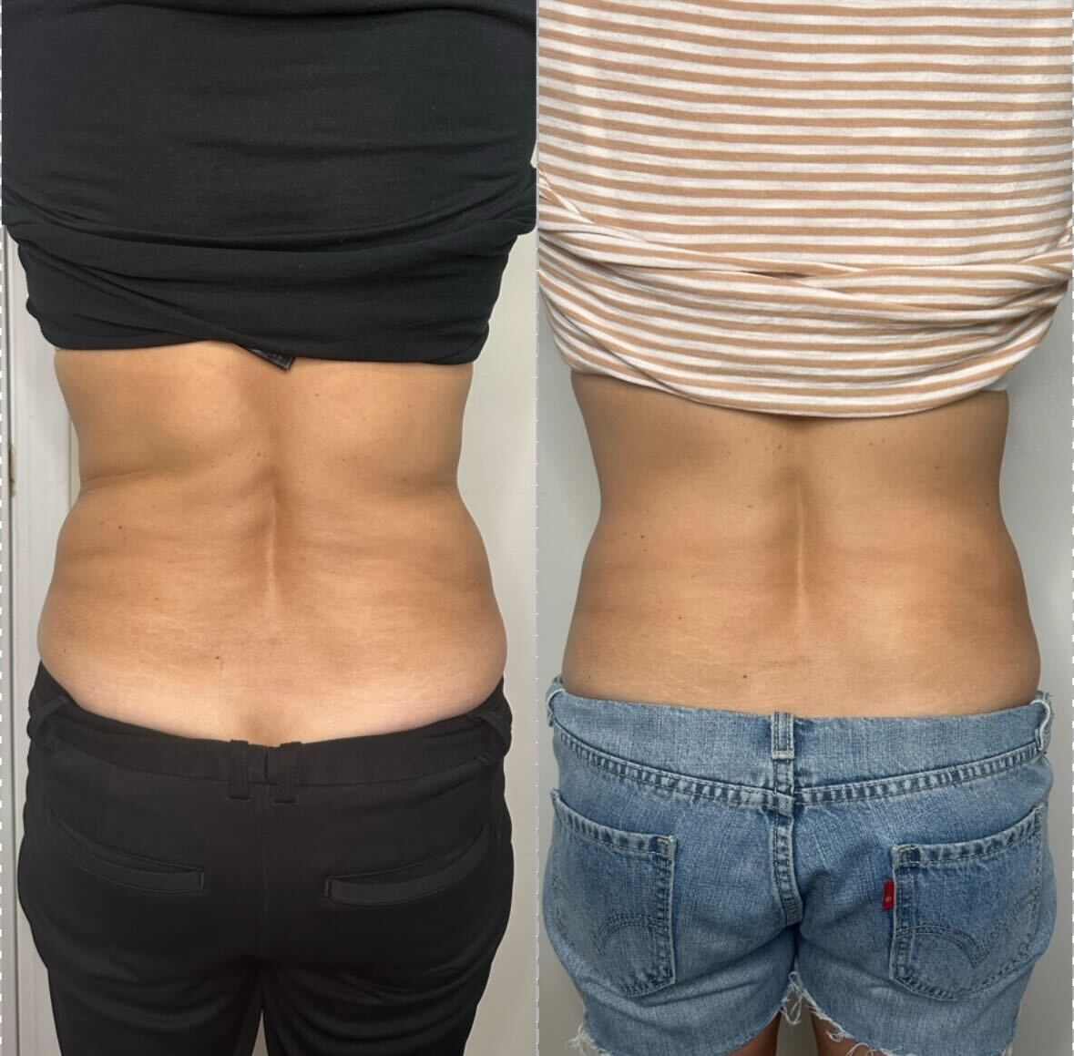 Before and after images of a woman's back, showing a reduction in fat and smoother skin.