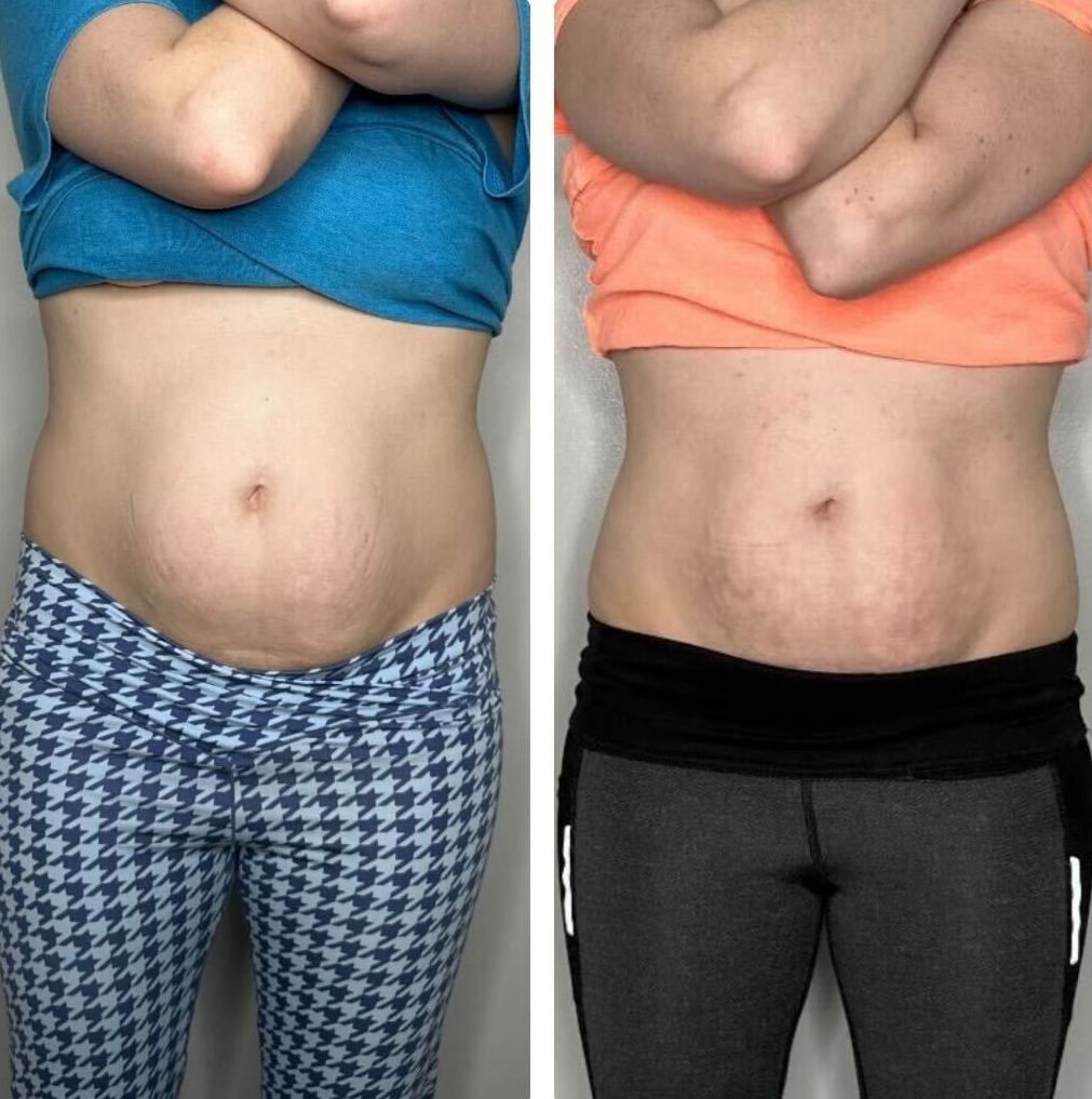 Side-by-side photos of a person's torso. Left shows blue top and patterned pants. Right shows orange top and gray pants.