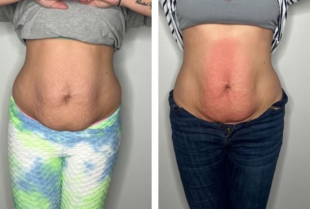 Two photos: a woman's abdomen before and after a procedure, showing redness in the after photo.