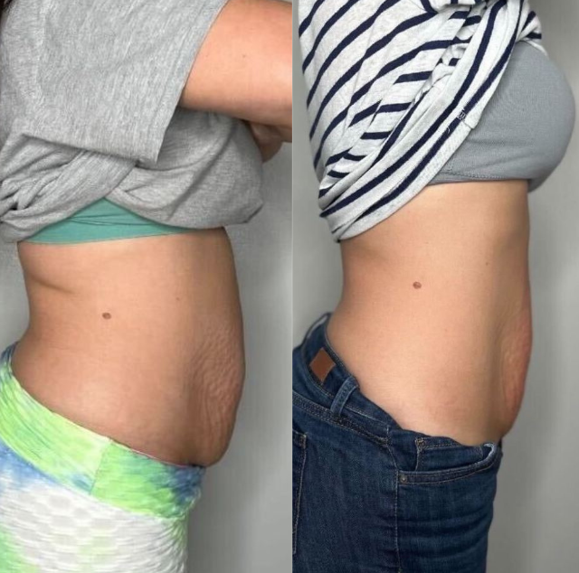 Side-by-side of a woman's abdomen, showing a reduction in belly fat.